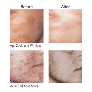 Pimple Eraser Acne Pad with Anti-Aging Glycolic